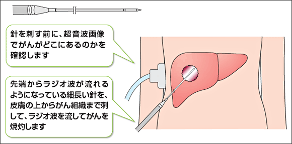 ラジオ波焼灼術（RFA）治療イメージ