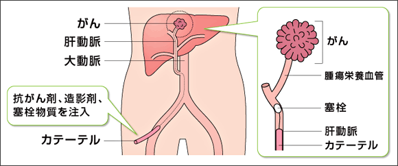 肝動脈塞栓療法（TACE）治療イメージ