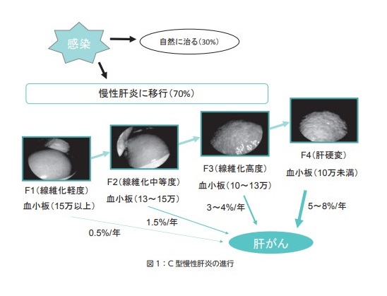 C型肝炎の進行　イメージ図